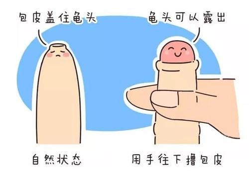 宝鸡割包皮虽是小手术,但需三思而后行