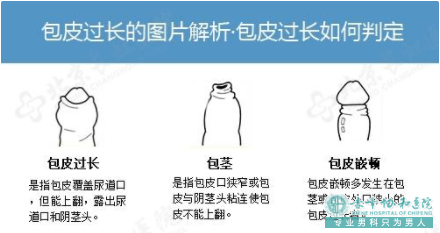 赤峰包皮虽小,但却包藏大麻烦,不容忽视! 赤峰包皮虽小,但却包藏大麻烦,不容忽视!
